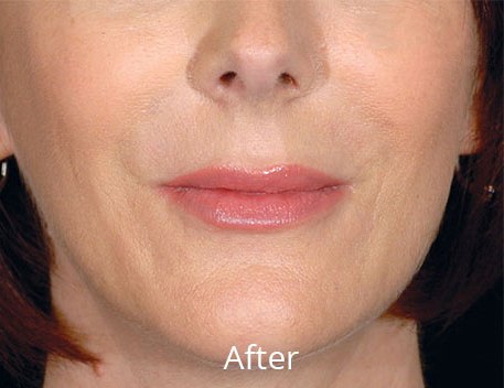 Restylane Case 2 - | Madison, CT | Aria DermSpa