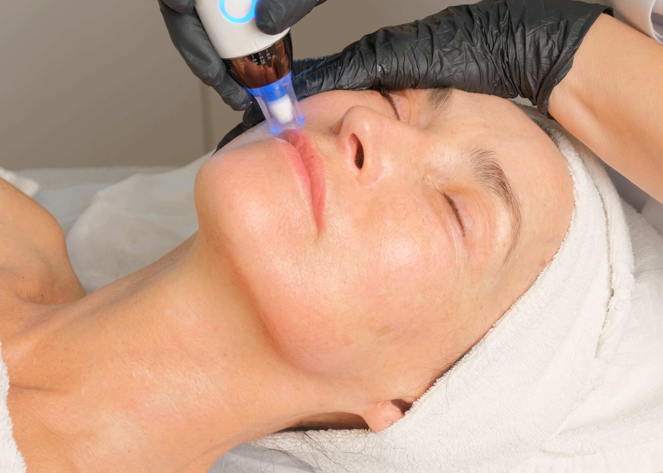 Close-up portrait of a beautiful aged woman during microneedling with dermapen from a dermatologist 