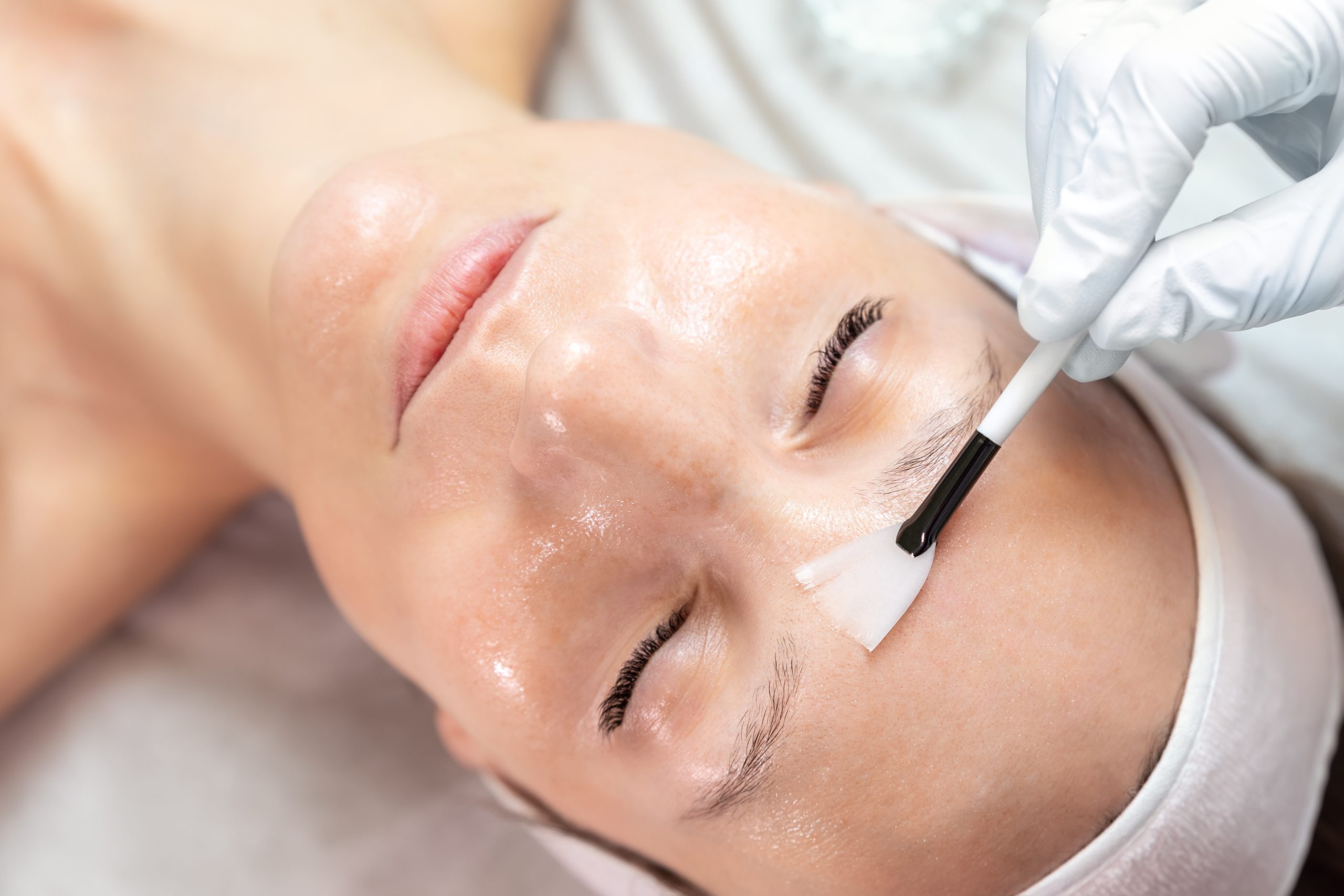 When Should You Get a Chemical Peel? The Best Timing, Skin Concerns, and Goals