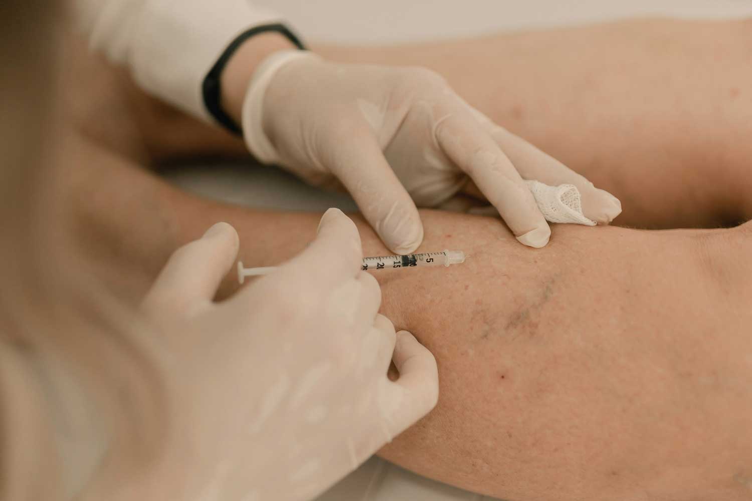 Fall Is Vein Season: What to Know Before You Treat Spider Veins
